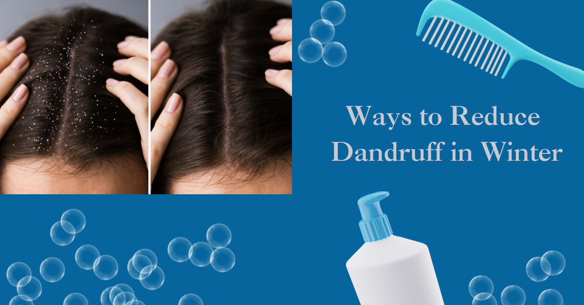 10 Amazing Ways to Reduce Dandruff in Winter - Iba Cosmetics