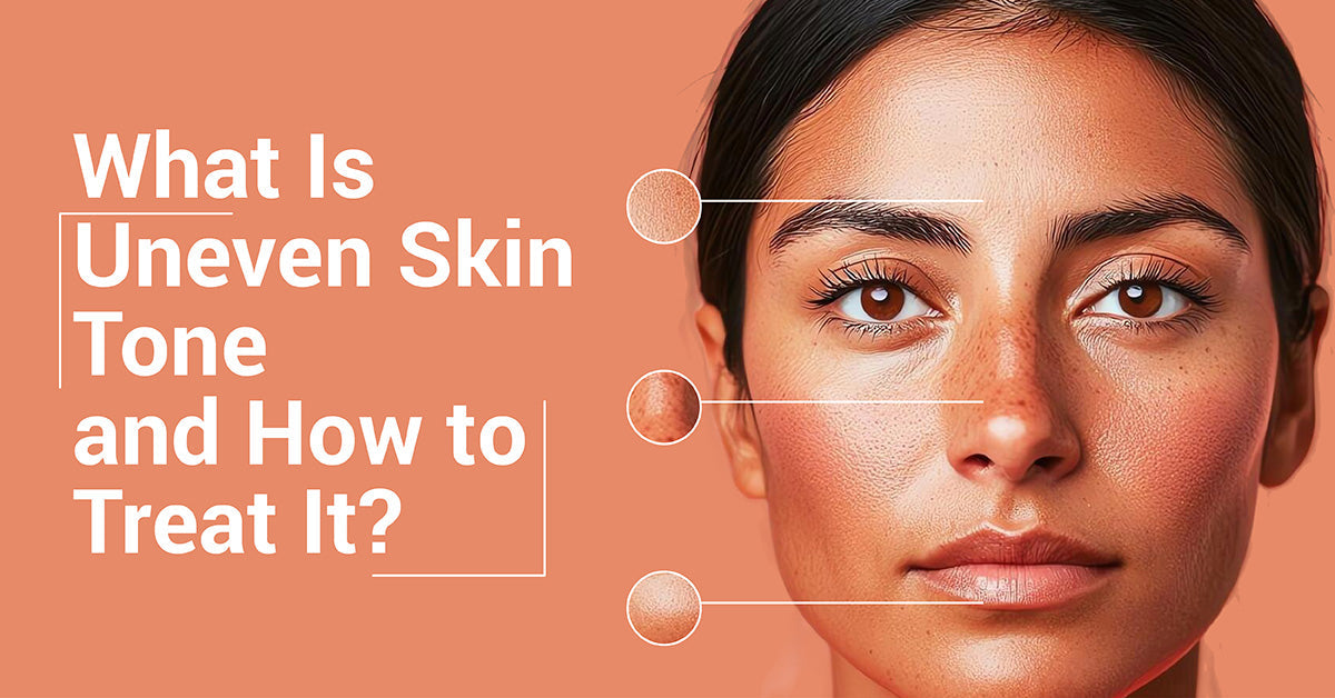 What Is Uneven Skin Tone and How to Treat It?