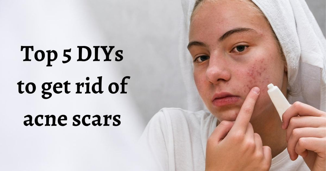 Top 5 DIYs to get rid of acne scars