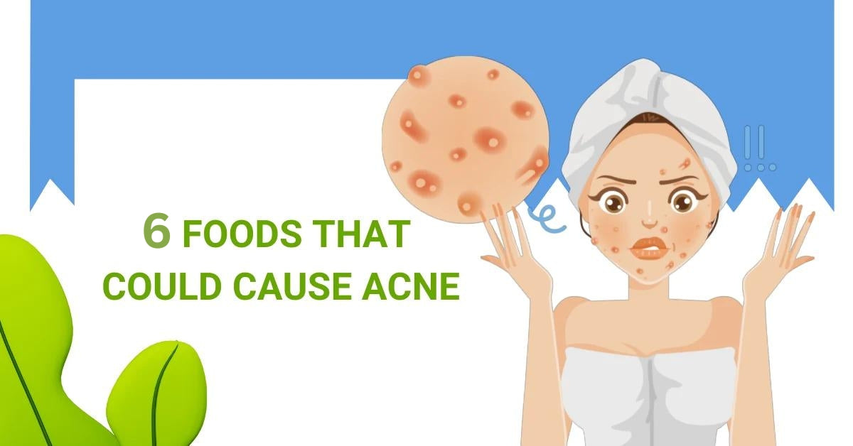 6 foods that could cause acne